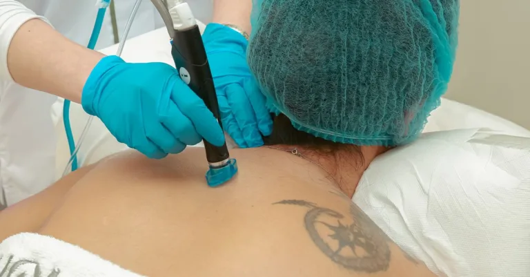 découvrez le coût de l'épilation définitive et les différentes options disponibles pour un investissement durable dans votre beauté.